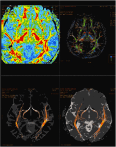 Tractografia y Neurofisiología intraoperatoria