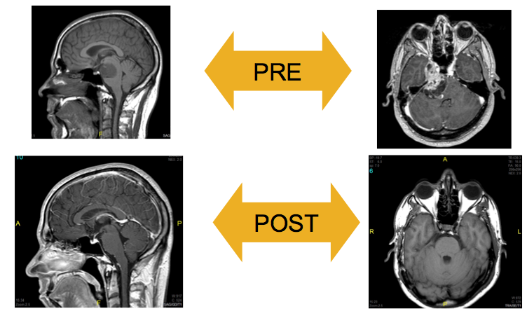 Tratamiento-Neurinoma del nervio trigemino