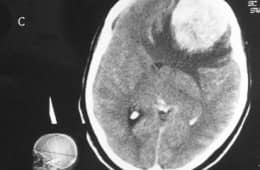 meningioma-gigante