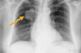 Se realiza estudio preoperatorio apareciendo en la placa de torax una masa a nivel de pulmón derecho que se confirma en el TAC torácico. Se realiza estudio de fibrobroncoscopia y se confirma la existencia de un carcinoma epidermoide pulmonar.