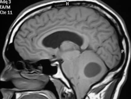 Se realiza estudio de RM cervical visualizando una lesión a nivel de cerebelo por lo que se amplia el estudio con RM craneal. En ella se observa una lesión quística a nivel de hemisferio cerebeloso derecho de gran tamaño, con efecto de masa y compresión del tronco cerebral y cuarto ventrículo. Captación de contraste en la zona basal de la lesión.