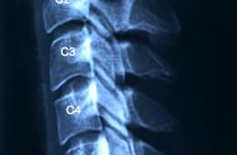 La RX de columna cervical muestra una inversión de lordosis fisiológica. Pinzamiento del espacio c5-c6 .
