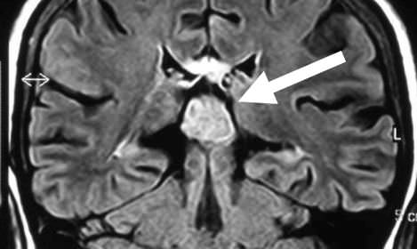 Los tumores de la región pineal, pineocitoma, tienen una incidencia inferior al 1% de todos los tumores intracraneales.