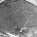 En la arteriografía no se observaba neoformación de vasos ni captaciones patológicas, solamente el desplazamiento de la arteria cerebral media y cerebral anterior por el tumor.