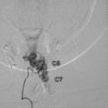 La angiografía medular mostró una malformación arteriovenosa dependiente de dos ramos arteriales situados a nivel radicular C6 y C7, con un gran nicho vascular y una vena de drenaje ascendente hasta C3.