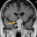 En la RM de cráneo, se observa una lesión localizada intra y supra selar. La lesíón capta contraste de forma homogénea y realza la duramadre: meningioma .