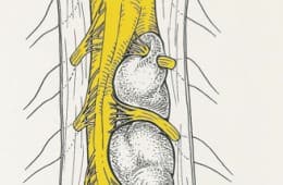 Laminectómía de las vértebras implicadas. Apertura de la duramadre visualizando un tumor que desplaza la médula y depende de raices nerviosas. Resección completa incluyendo componente extraforaminal.