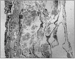 Lámina aracnoidea humana. Espesor completo. La capa de células aracnoideas de barrera se encuentra delimitada entre las dos. Microscopia electrónica de transmisión