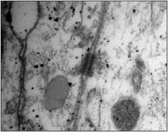 Detalle de uniones especializadas de membrana entre células aracnoideas de la capa barrera, y del espacio intercelular mínimo. Detalle de un desmosoma. Microscopía electrónica de transmisión