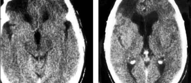 Meningiomas de fosa posterior