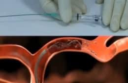 Extracción del coágulo mediante el cateter-stent introducido por la femoral