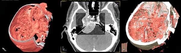 neuronavegador-meningioma-rgsola