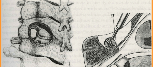 Posterior lamino-foraminotomy