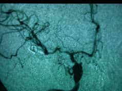 Aneurismas-Control angiográfico tras el clipaje del aneurisma de la figura 6