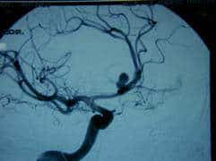 Arteriografía con aneurisma de comunicante anterior