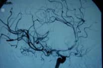 Control angiográfico tras embolización