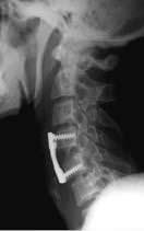 RX lateral de columna cervical. Control radiológico tras colocar una placa para realizar la artrodesis