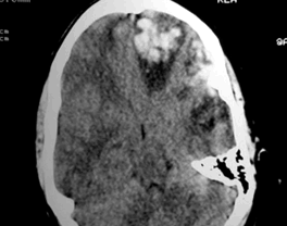 Traumatismo craneoencefalico-TAC craneal con foco de contusión cerebral frontal