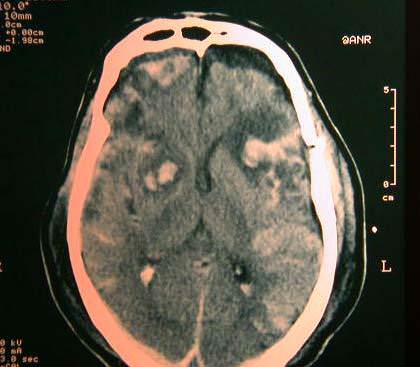 Traumatismo craneoencefalico-TAC craneal con focos de contusión múltiples intracerebrales
