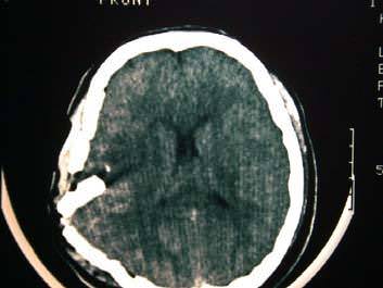 traumatismo craneoencefalico TAC craneal con fractura con hundimiento e impacto del hueso en el cerebro