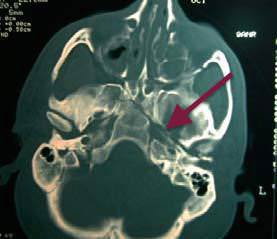 Traumatismo craneoencefalico-TAC craneal con fractura de base de cráneo