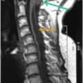 Chiari I. Consiste en un desplazamiento caudal de las amígdalas cerebelosas mayor de 5 mm en el canal cervical.