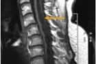 Chiari I. Consiste en un desplazamiento caudal de las amígdalas cerebelosas mayor de 5 mm en el canal cervical.
