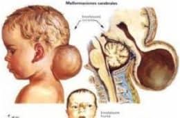 Chiari III: Consiste en encefalocele occipital + parte de las anomalías intracraneales asociadas al Chiari II