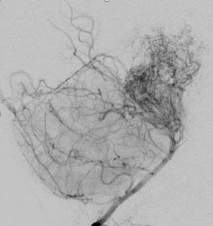 1-moyamoya-disease