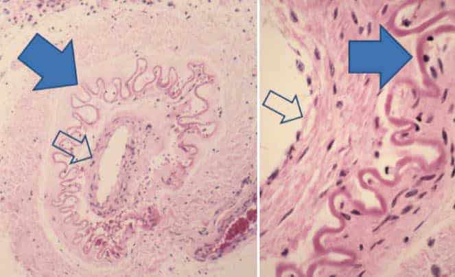 patologia-moyamoya-disease