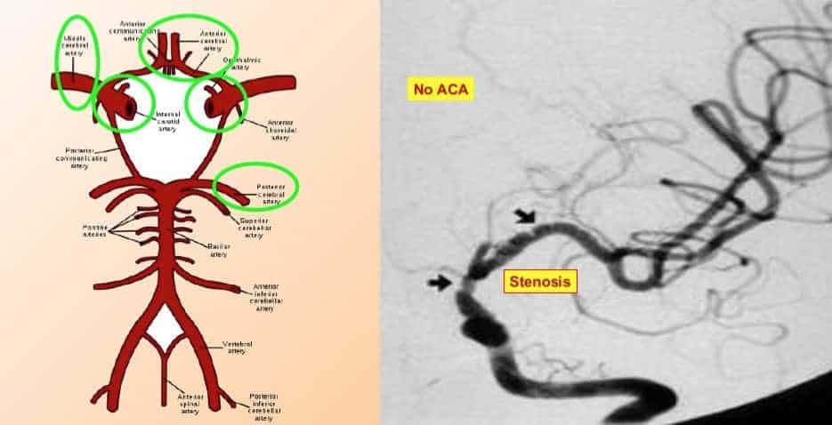 Vascular stenosis