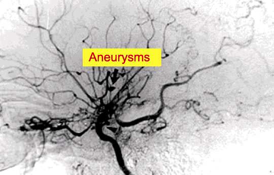 aneurisma