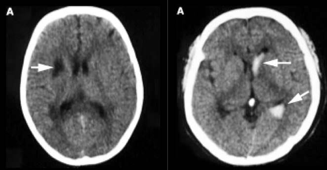 Infarction: may involve cortical and subcortical regions