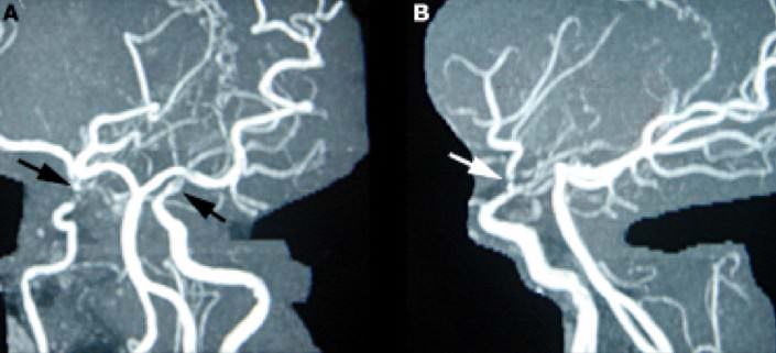 Stenotic or occlusive lesions in the distal internal carotid arteries