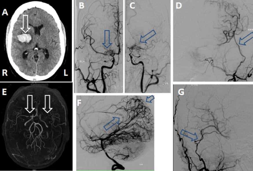 severe stenosis of the supraclinoid carotid and middle cerebral artery