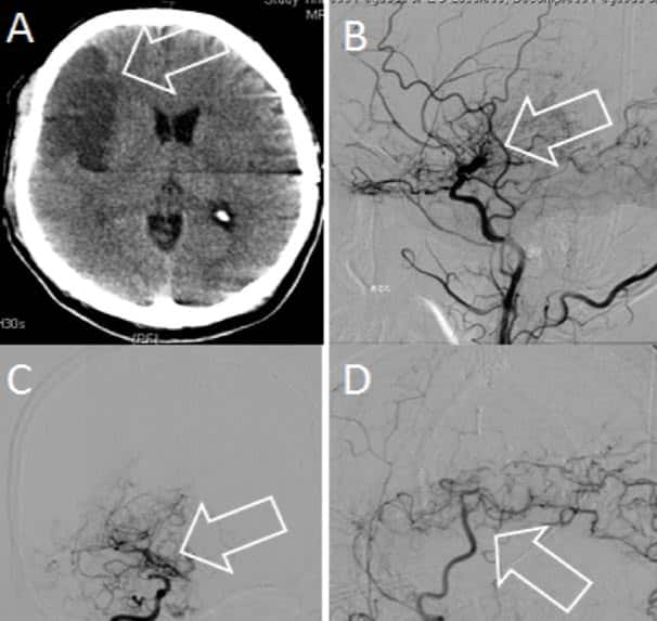 acute infarction on CT (A) caused by ischemic moyamoya in an adult