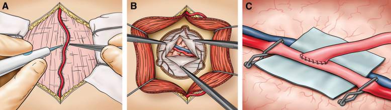 Superficial temporal artery to middle cerebral artery (MCA) bypass or middle meningeal artery
