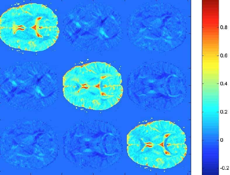 Tractografía por tensor de difusión