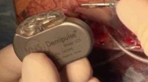 estimulacion-vagal-epilepsia