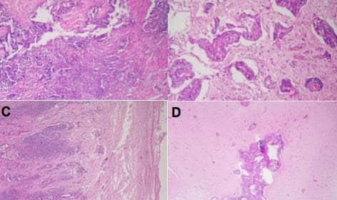 Fig. 3.- Anatomía patológica. (A) Zonas necróticas y abscesificadas. HE/100X. (B) Carcinoma con claro patrón glandular. HE/100X (C) Infiltración meníngea. HE/40X (D) Infiltración de parénquima cerebral. HE/40X.