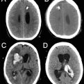 colocación de drenaje ventricular externo