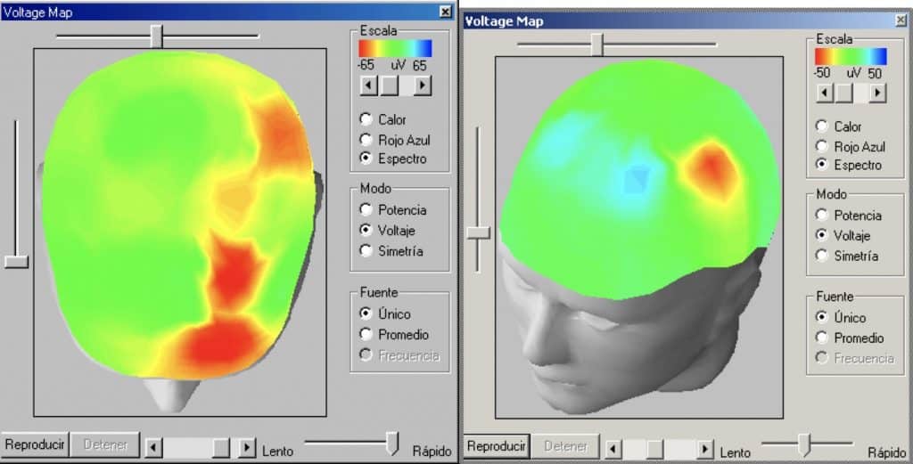 Figura 1. Ejemplo de mapas de voltaje en un EEG digitalizado.