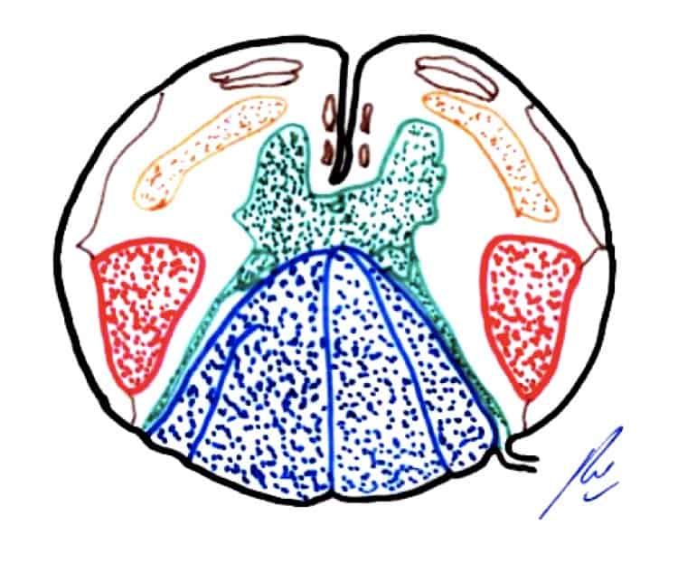 Figura 1.- Esquema de una sección anatómica medulas a nivel torácico. Azul: Cordones Posteriores. Rojo: Haz Piramidal. Naranja: Haz Espino-Talámico. Verde: Astas medulares.
