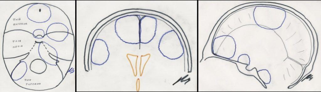 Figura 1.- Esquemas con la distribución y localización más frecuente de los meningiomas en los tres planos axial, coronal y sagital