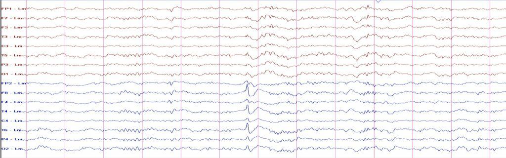 Figura 2. Actividad interictal durante el sueño superficial. Punta-onda de 190 µV (p-p) con máximo en región temporal anterior derecha.