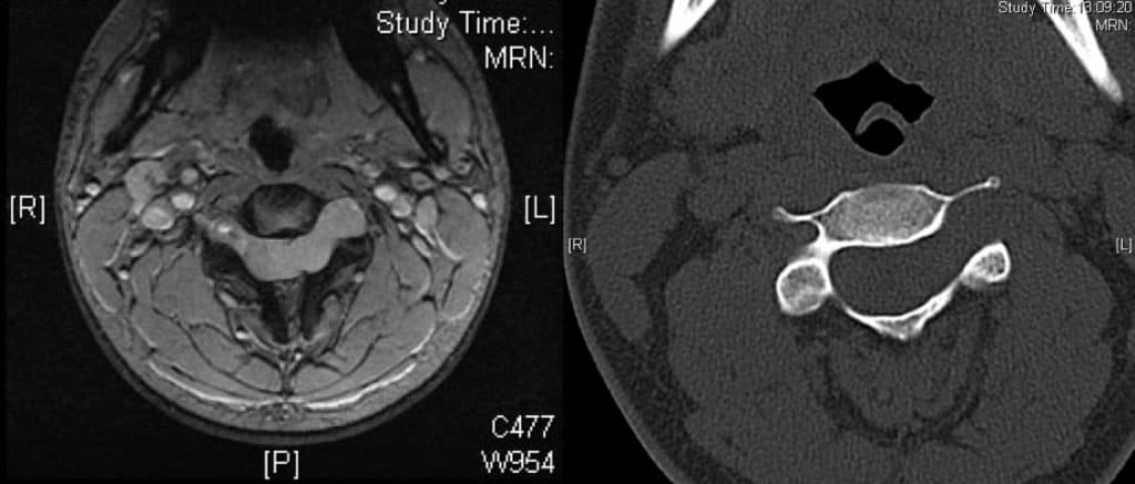 Figura 2.- Agrandamiento del agujero de conjunción por un neurinoma a nivel cervical