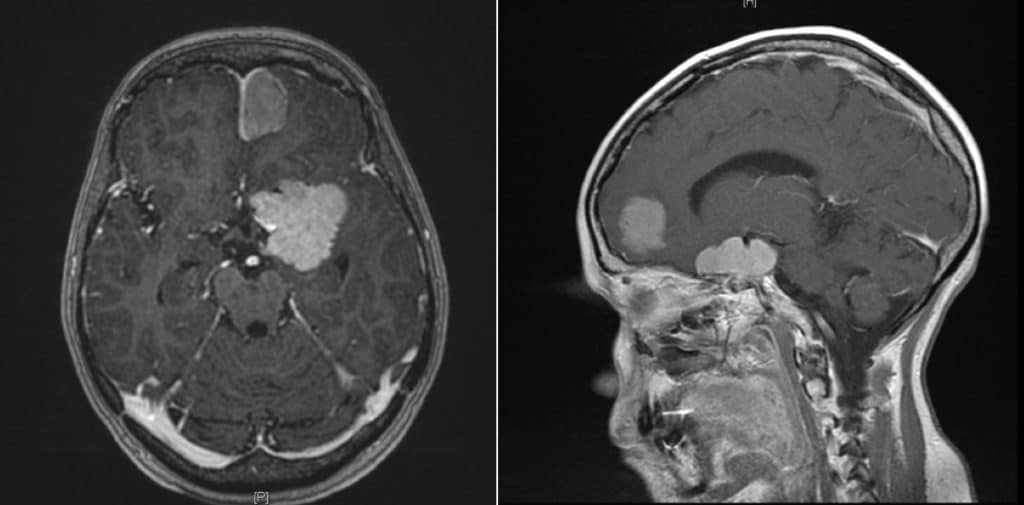 Figura 2.- Meningiomatosis múltiple . Tumores localizados en la hoz y otra lesión paraselar.