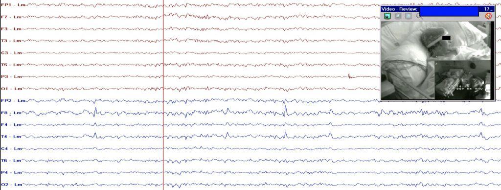 Figura 3.  Ejemplo de registro de v-EEG de scalp. En la parte superior derecha se puede observar la imagen del paciente en el momento indicado por la línea vertical. Hay dos cámaras simultáneas. Una para la visión global del paciente y otra para un detalle más específico, dependiendo del tipo de crisis epiléptica que tenga el paciente.