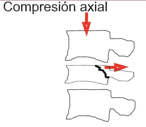Figura 3.- Esquema de fractura por compresión