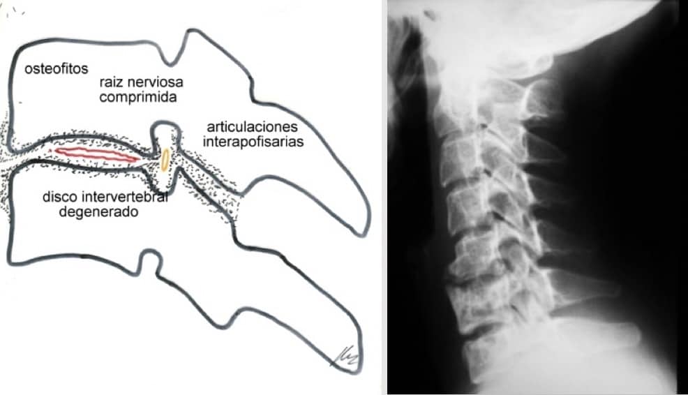 Figura 3.- Esquema y RX columna cervical con degeneración del espacio C5-C6